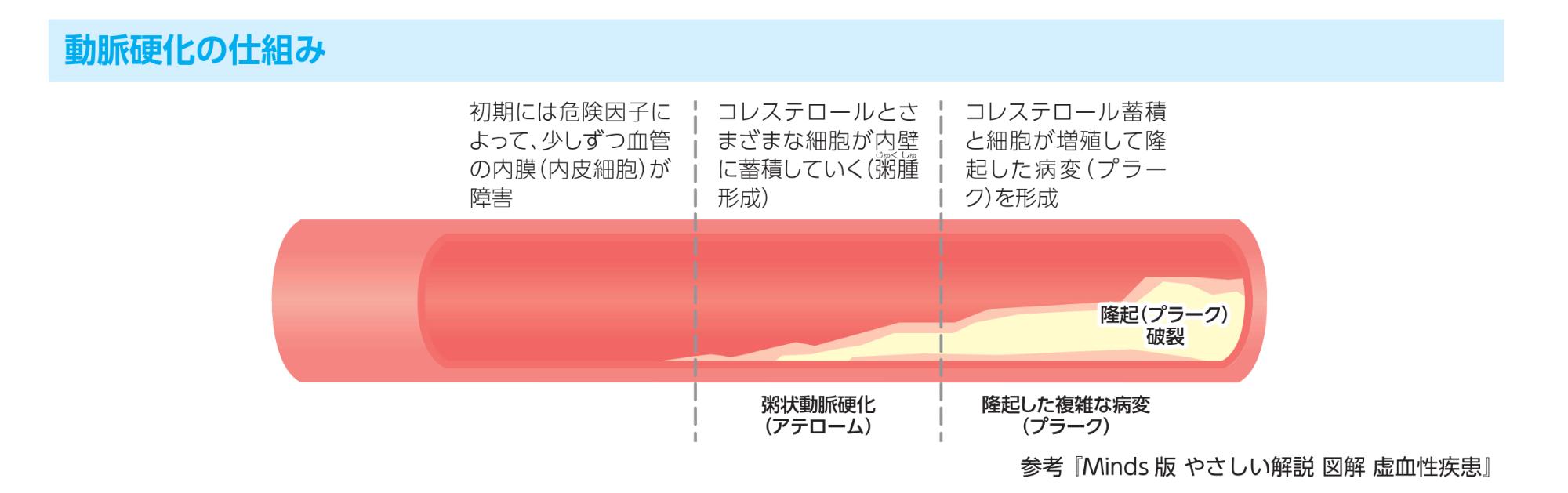 動脈硬化の仕組み